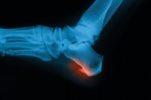 What Is Cuboid Syndrome and How Can It Be Treated?