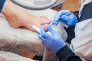 Toenail Fungus Is a Common Infection