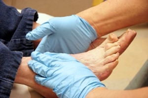 Diabetic Foot Blisters