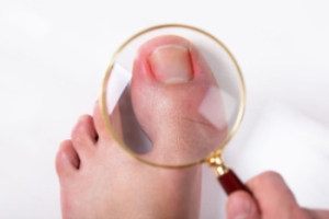 Managing Ingrown Toenails