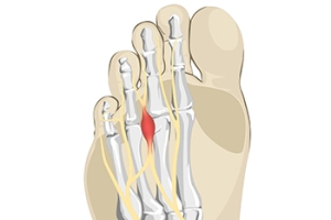 Running With Morton’s Neuroma