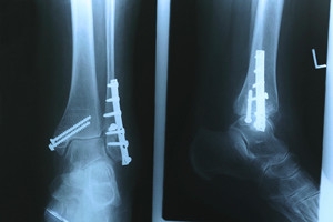 Foot and Ankle Stress Fractures